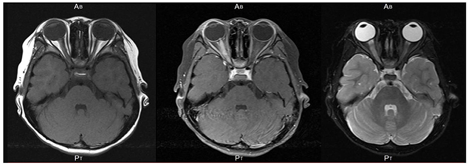 optic neuritis anti mog optic neuritis anti mog