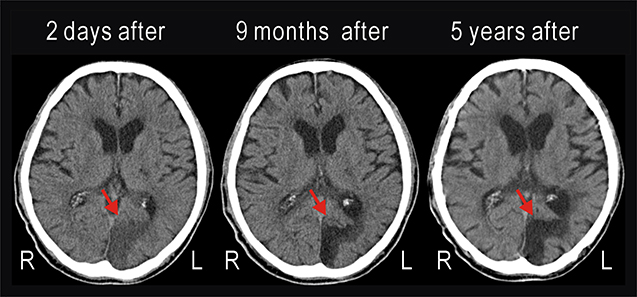 Occipital Lobe Damage: How It Affects Vision & Recovery