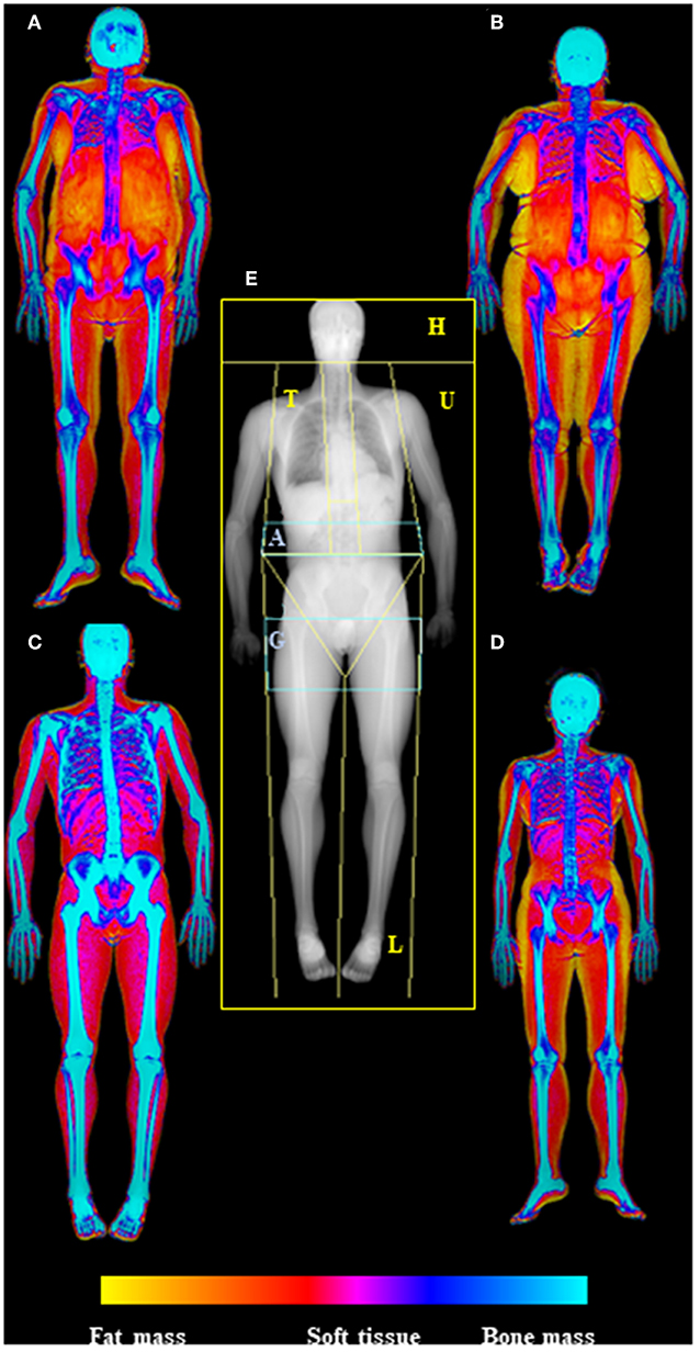 Hydrostatic weighing and body fat distribution patterns