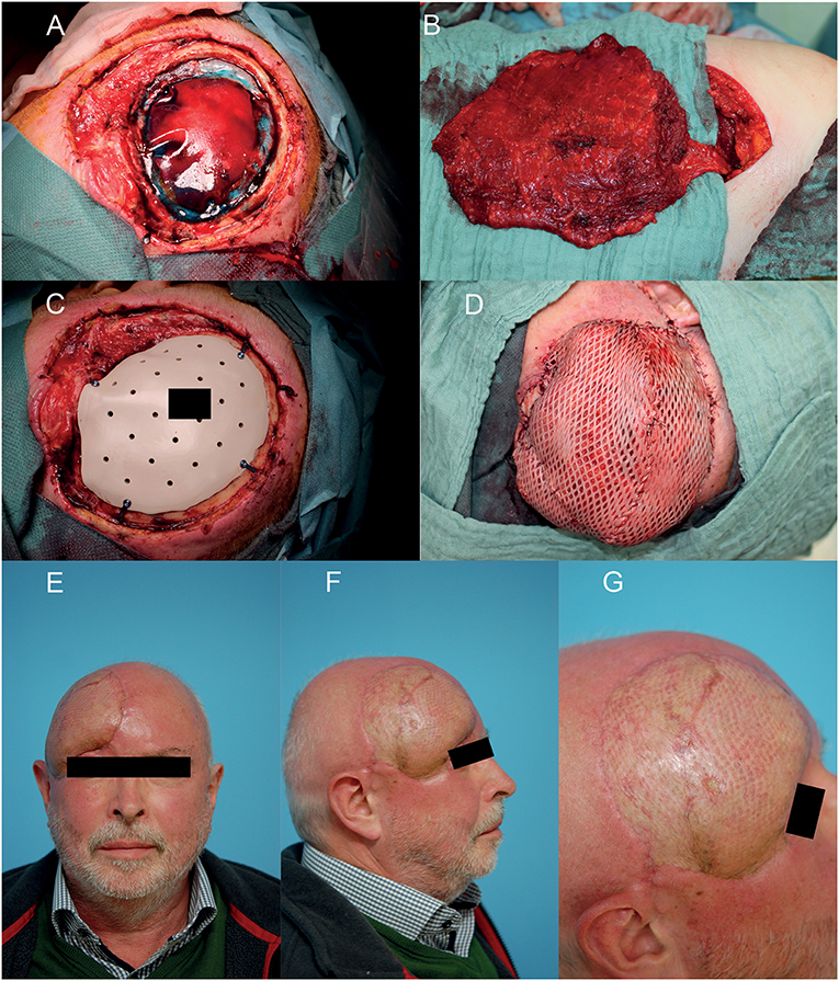 Frontiers | A Standard Algorithm for Reconstruction of Scalp