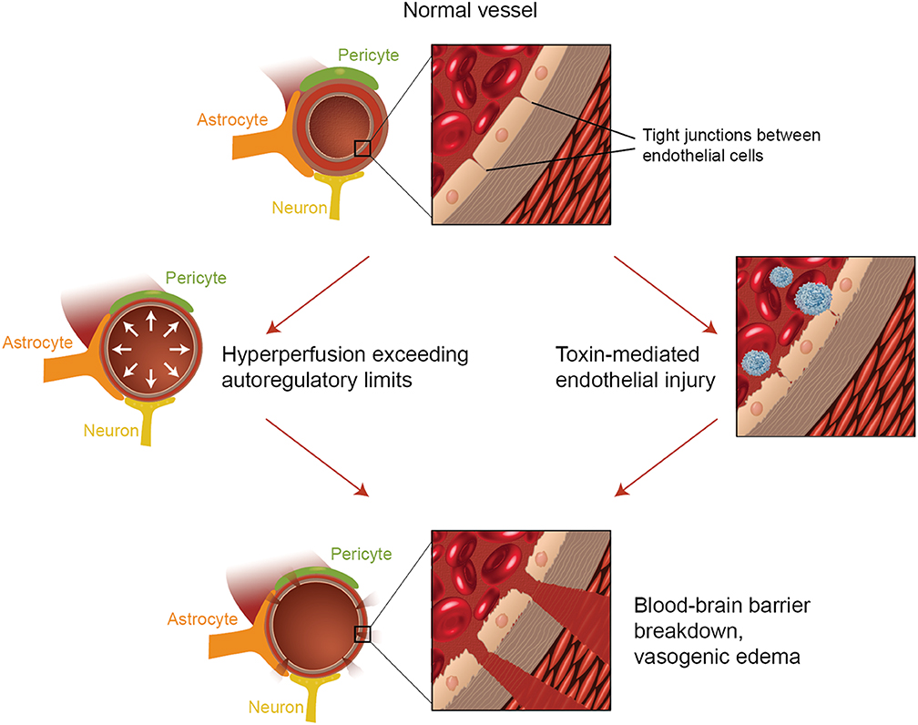 pres syndrome presentation