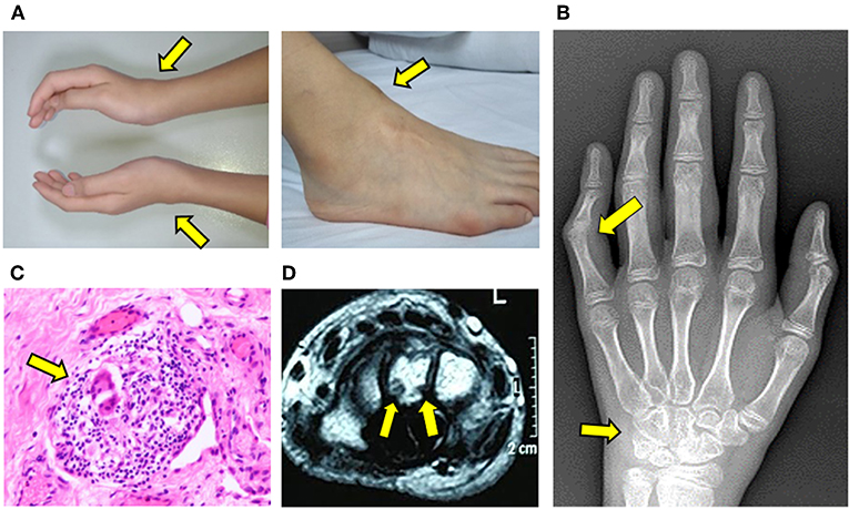 Frontiers Giant Cell Tumor Of Tendon Sheath And Tendinopathy As Early