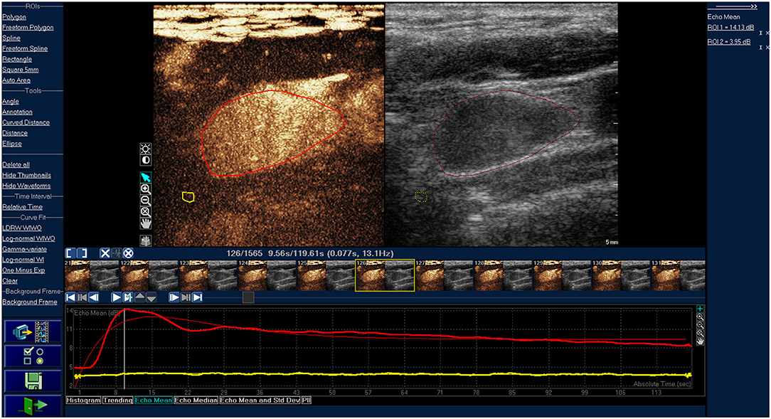 Frontiers The Value Of Ceus In Distinguishing Cancerous Lymph Nodes