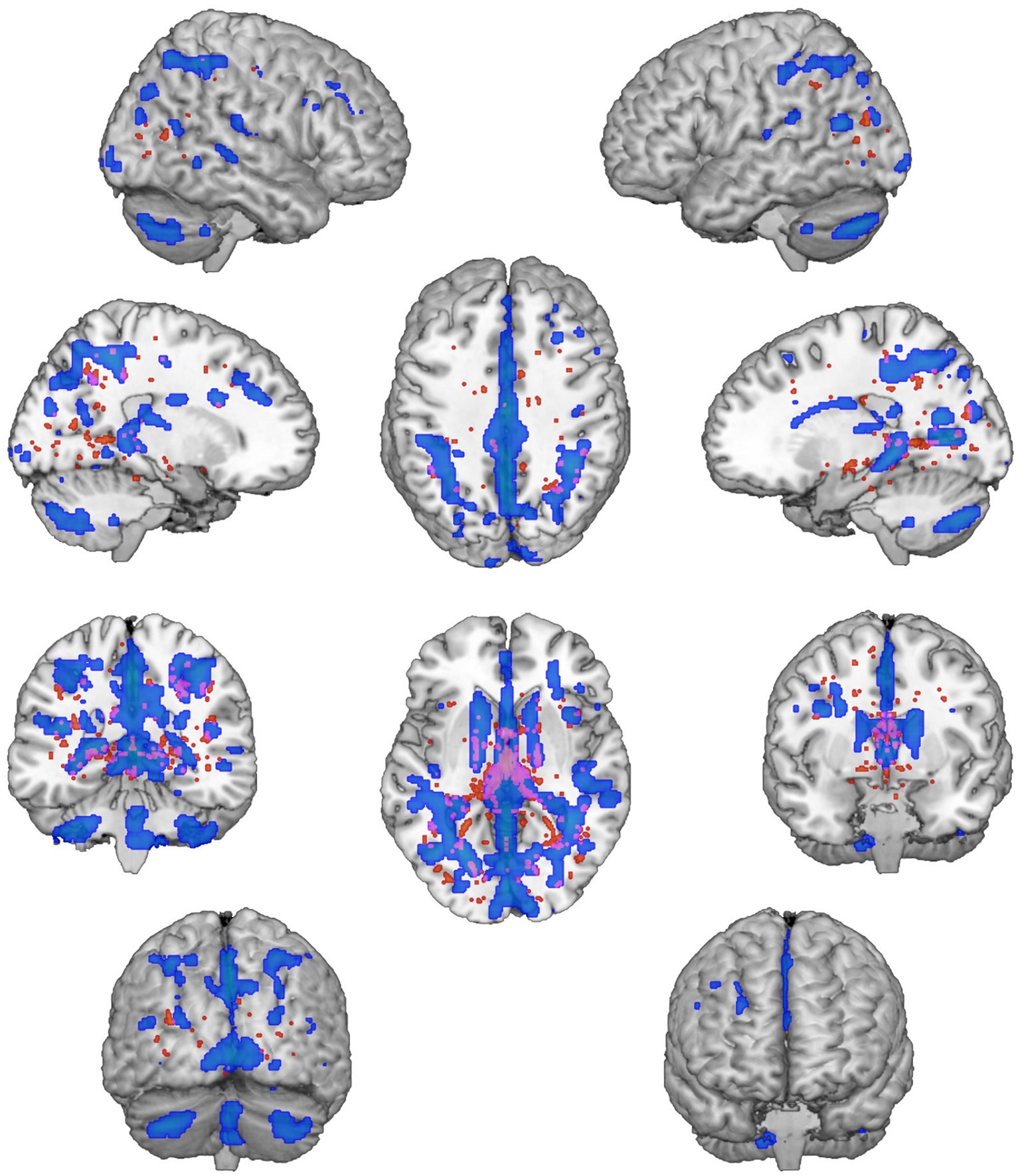 Frontiers Executive Impairment in Alcohol Use Disorder Reflects Structural Changes in Large-Scale Brain Networks A Joint Independent Component Analysis on Gray-Matter and White-Matter Features picture