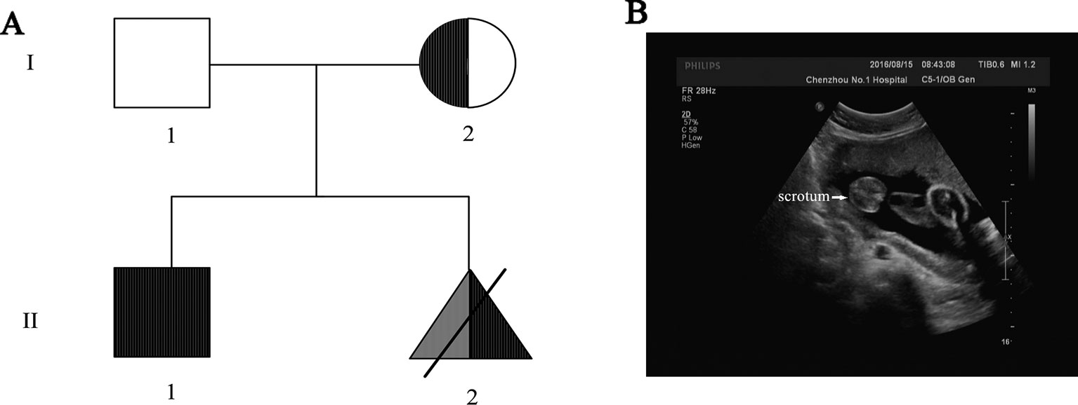 Frontiers 46,XX Testicular Disorders of Sex Development With DMD Gene Mutation First Case Report Identified Prenatally by Integrated Analyses in China