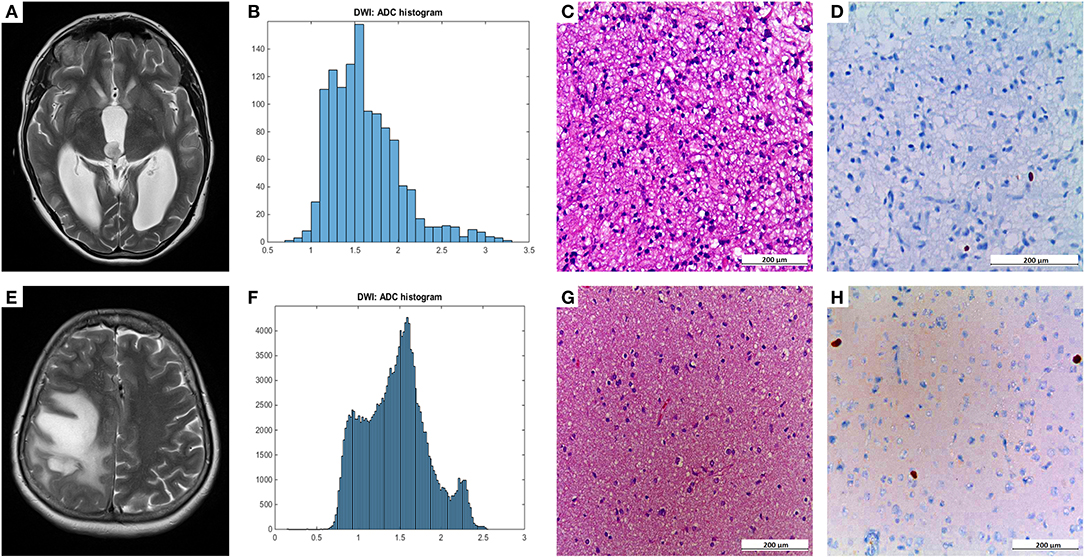 Frontiers Histogram Analysis of Diffusion Weighted 