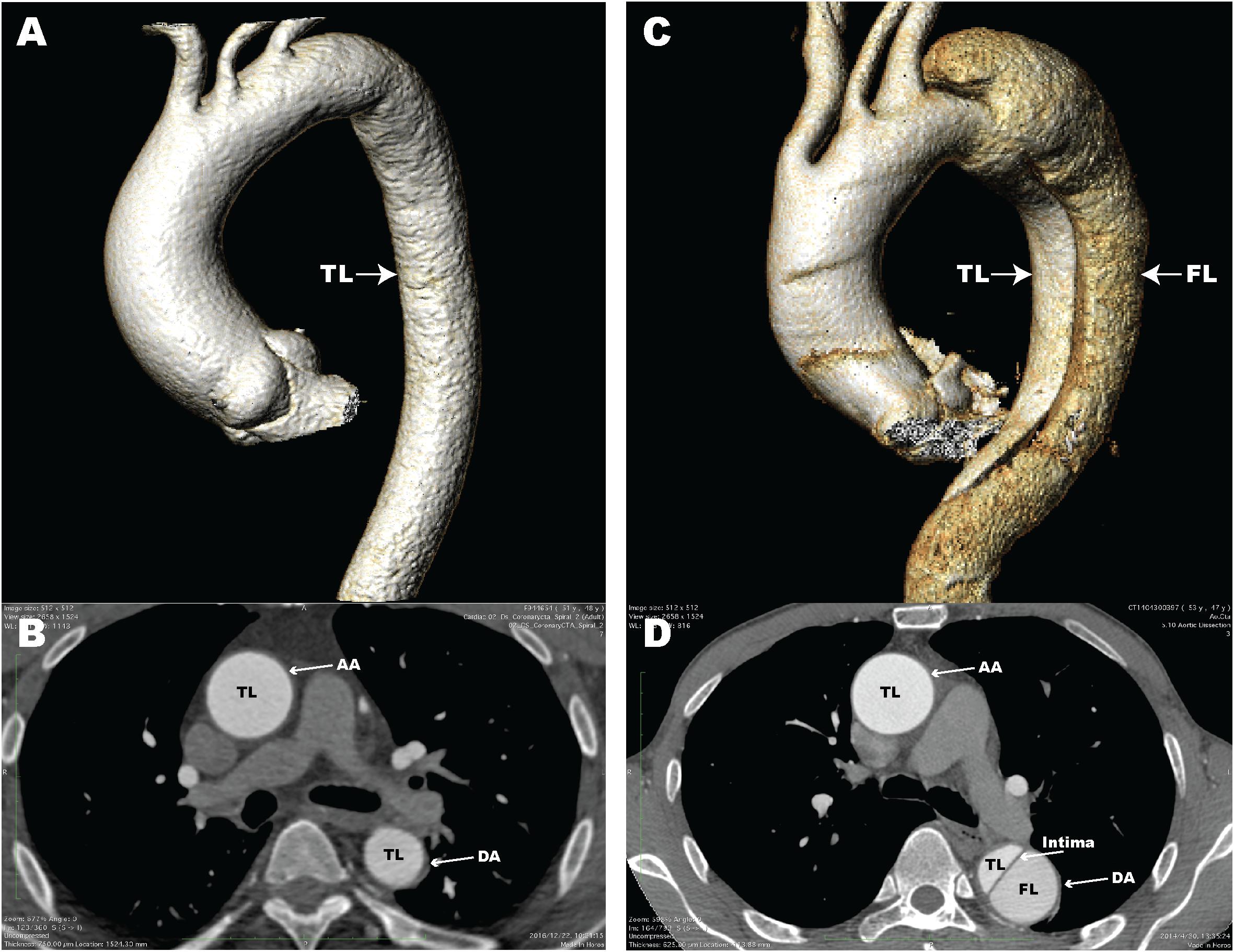 Frontiers The Role Of Macrophages In Aortic Dissection Physiology frontiers-the-role-of-macrophages-in-aortic-dissection-physiology