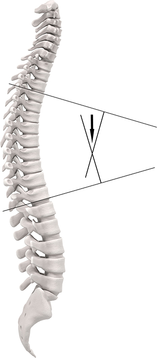 Frontiers  The Clinical Relevance of Hyperkyphosis: A Narrative Review