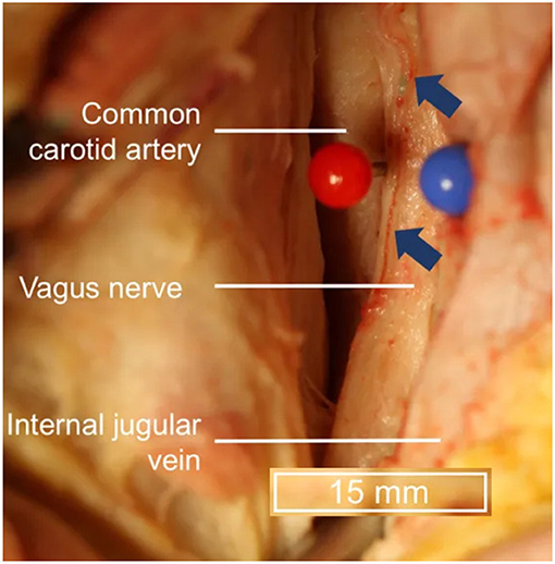Understanding Vagus Nerve Stimulator (VNS) Placement