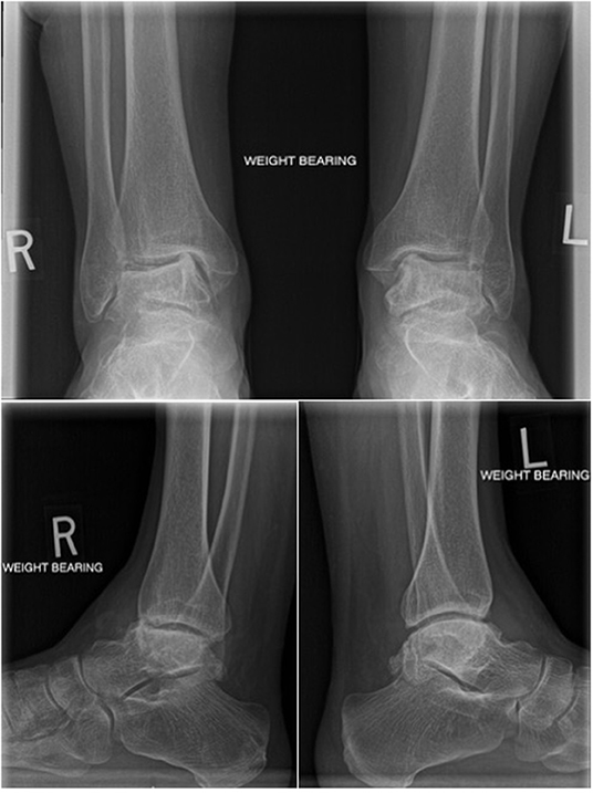 Weight bearing versus non-weight bearing ankle dorsiflexion