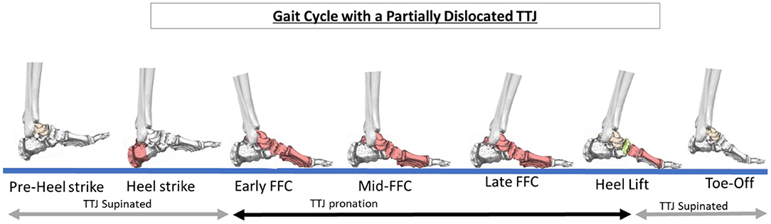 Flexible Vs. Rigid Flatfoot Condition in Kids - The Center Oregon