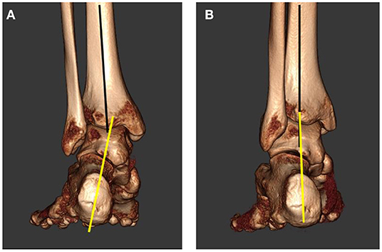 Flexible Vs. Rigid Flatfoot Condition in Kids - The Center Oregon