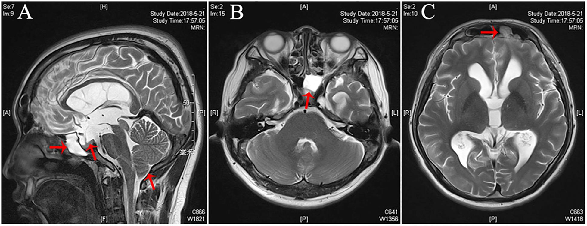 Cerebrospinal fluid leak