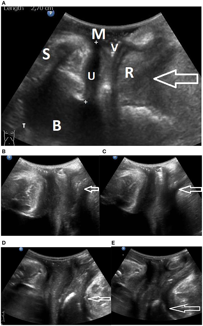 Frontiers | The Engagement of the Pelvic Floor Muscles to the Urethra