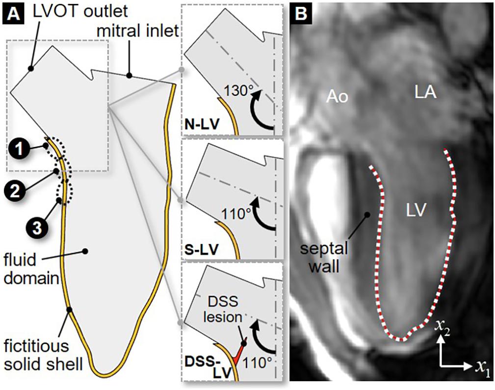 Measuring Left Ventricular Outflow Tract Signal Gradient in