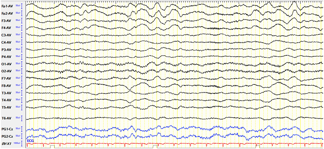 Frontiers | Clinical and Electroencephalographic Features of the Seizures in Neuronal Surface ...