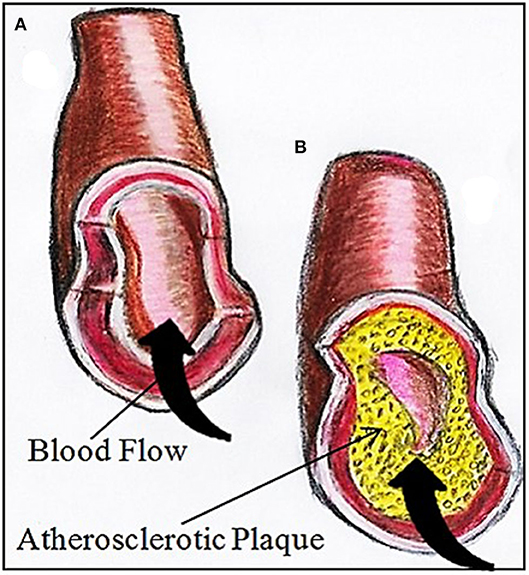 Figure 2 - (A) A normal artery should have smooth and wide inner walls, allowing the blood to flow freely with no restrictions.