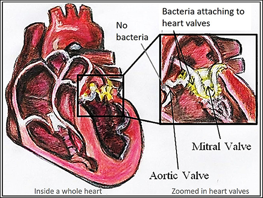 Figure 3 - Bacterial endocarditis infecting two heart valves.
