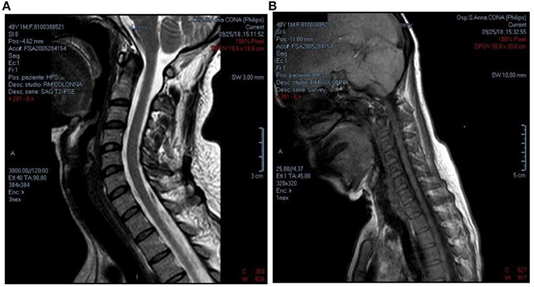 Frontiers | Hirayama Disease: A Case of an Albanian Woman Clinically ...