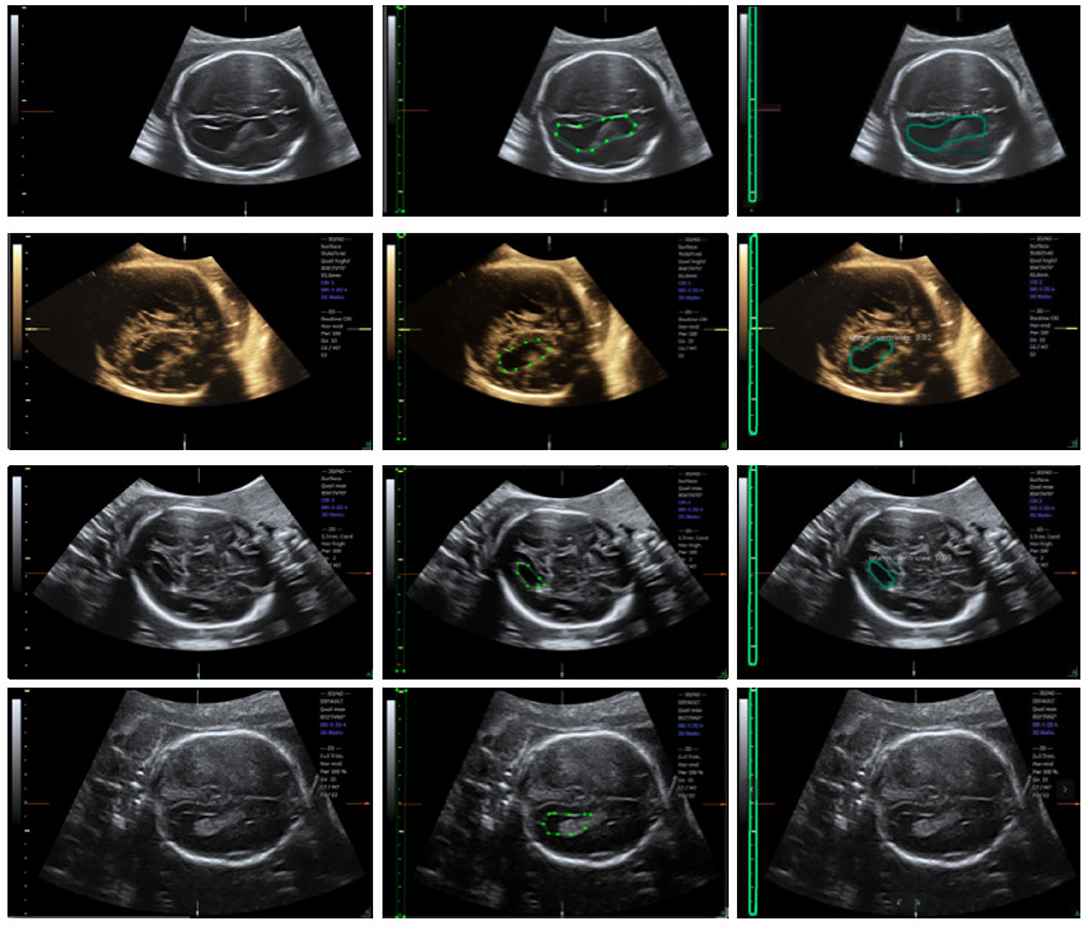 Frontiers Automatic Measurements Of Fetal Lateral Ventricles In 2d