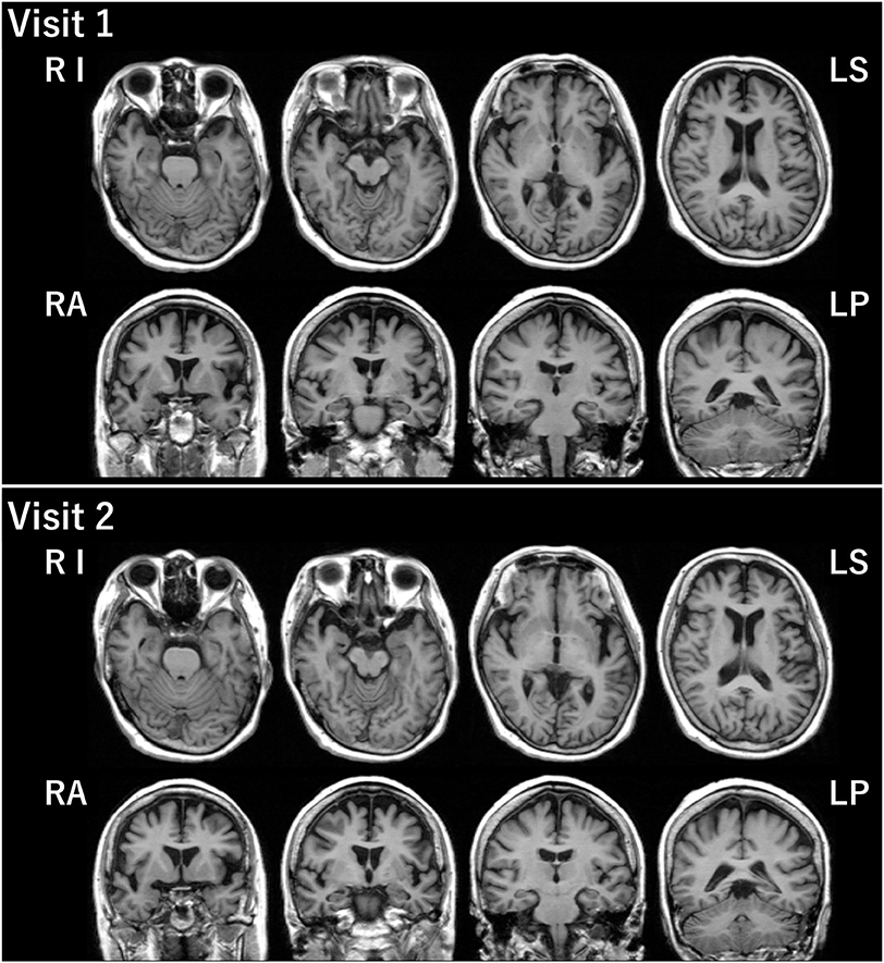 Frontiers | Primary Progressive Aphasia as a Prodromal State of ...