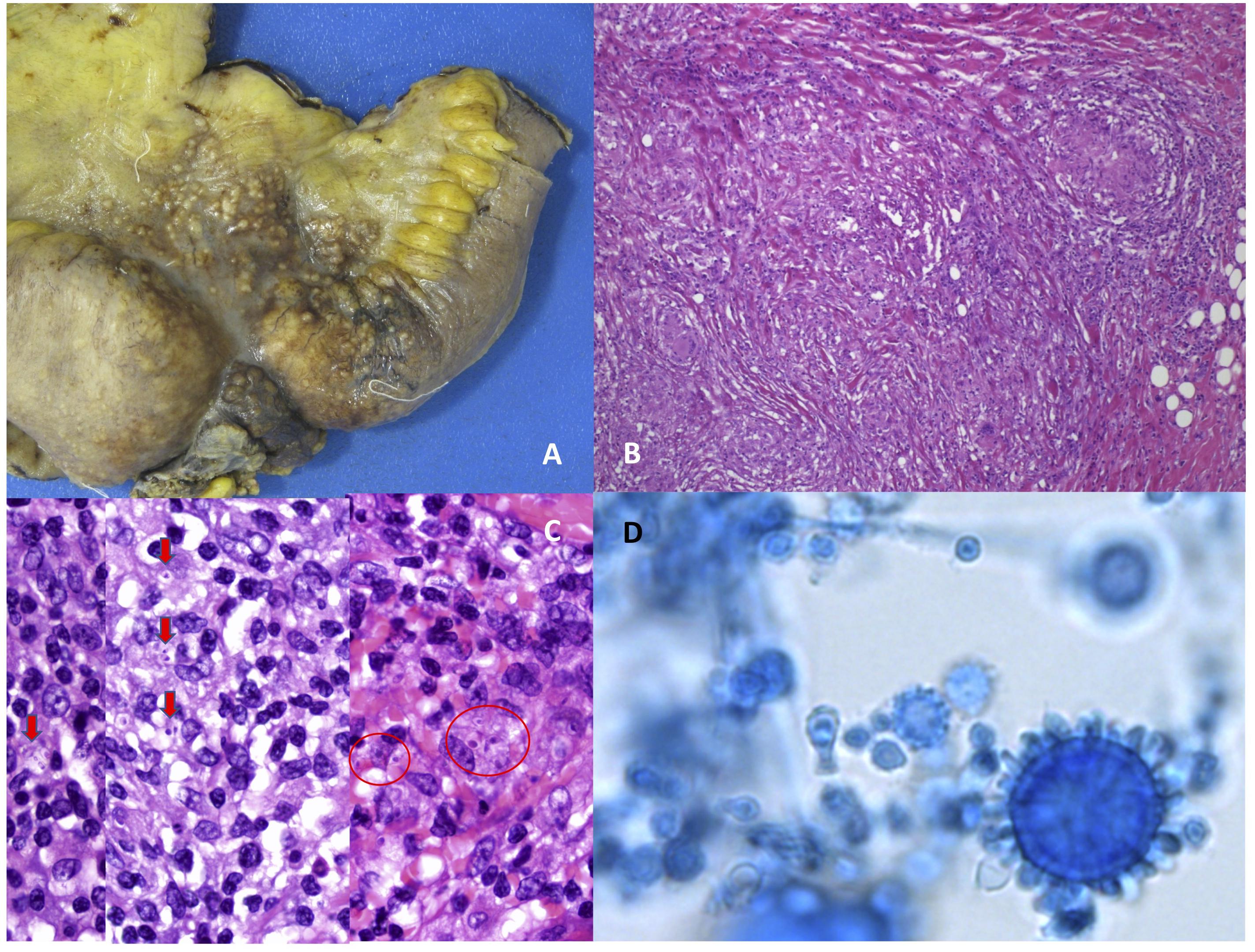 hpv és mycosis