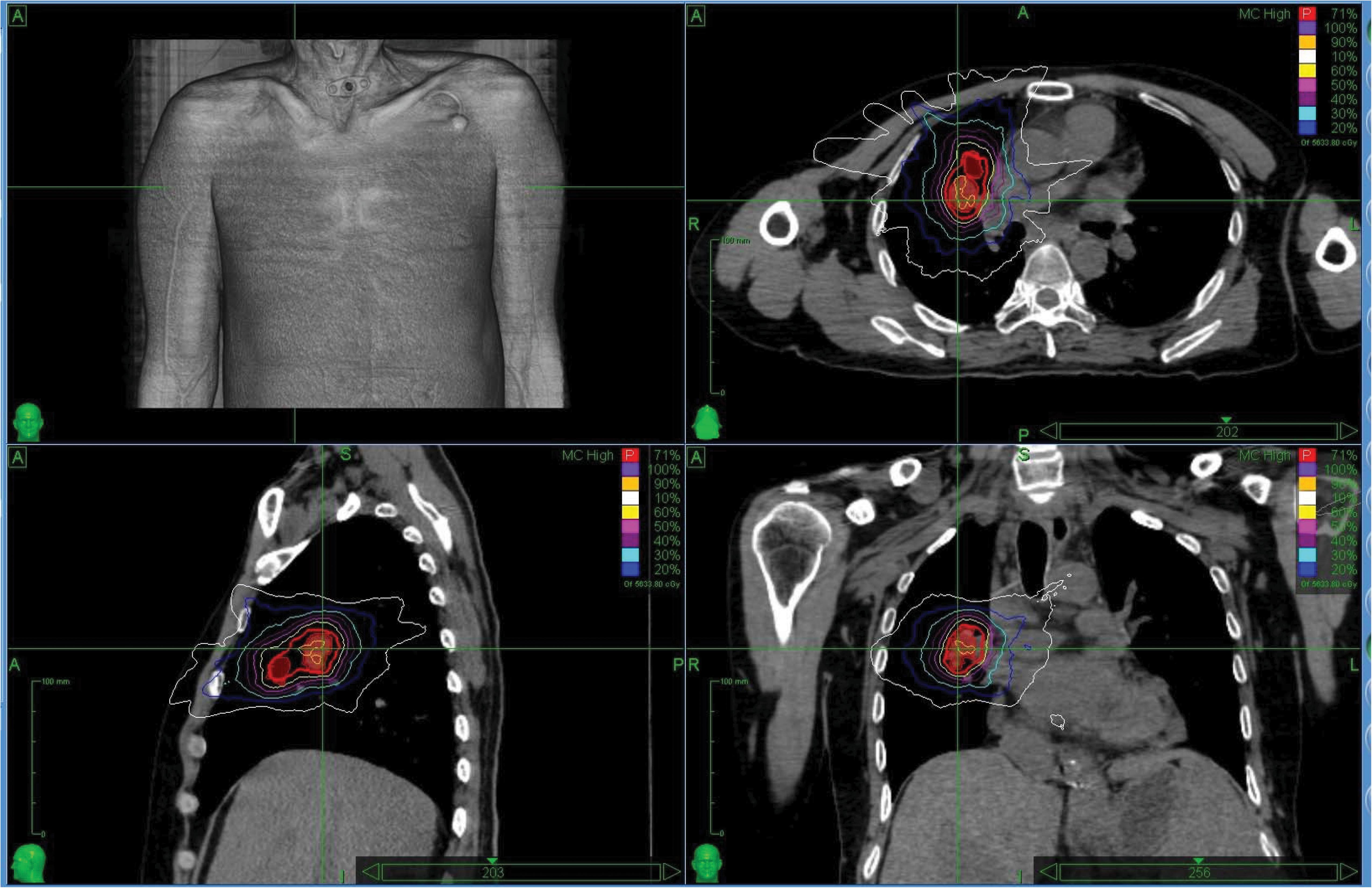 what is invasive well differentiated squamous cell carcinoma