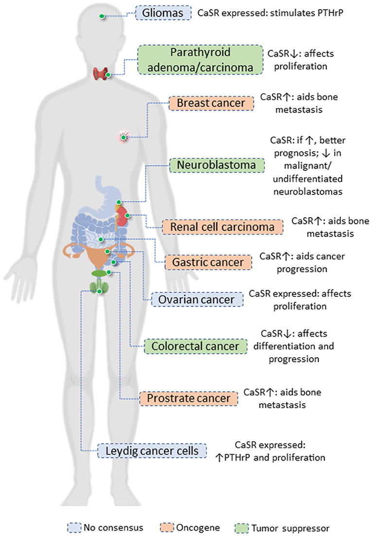 metastatic cancer bone