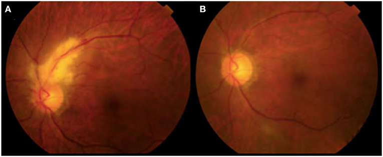 cmv retinitis