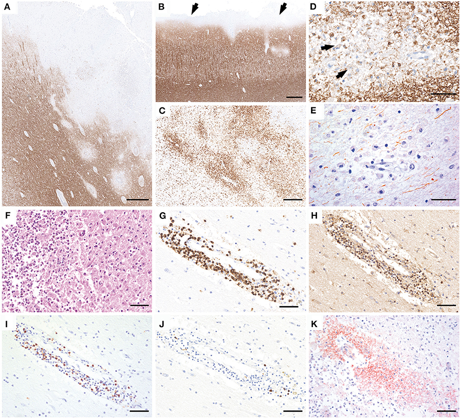 anti mog encephalomyelitis
