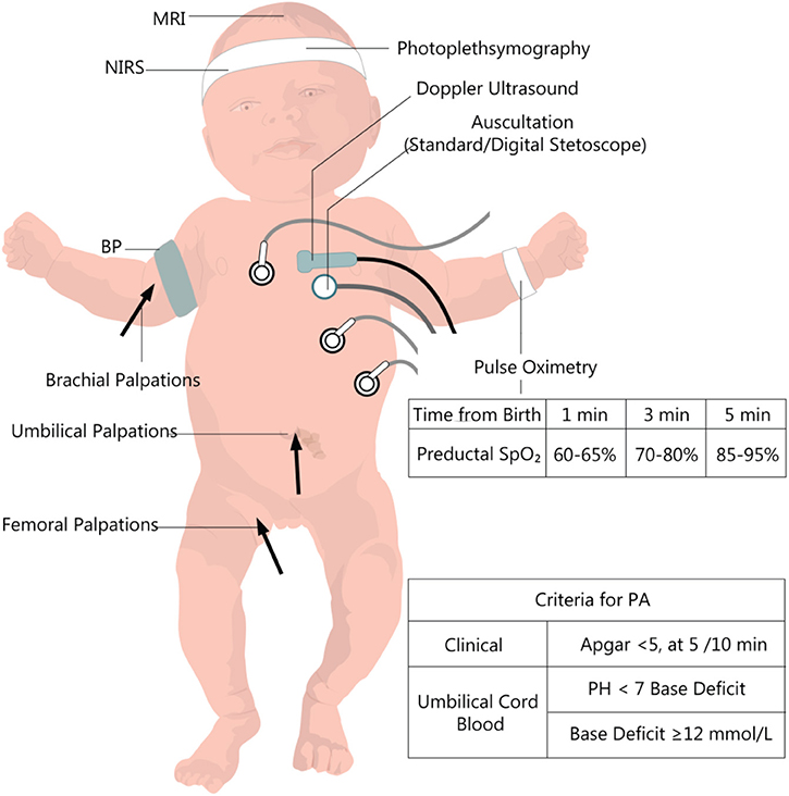 Neonatal Asphyxia Project — M-HEAL at the University of Michigan