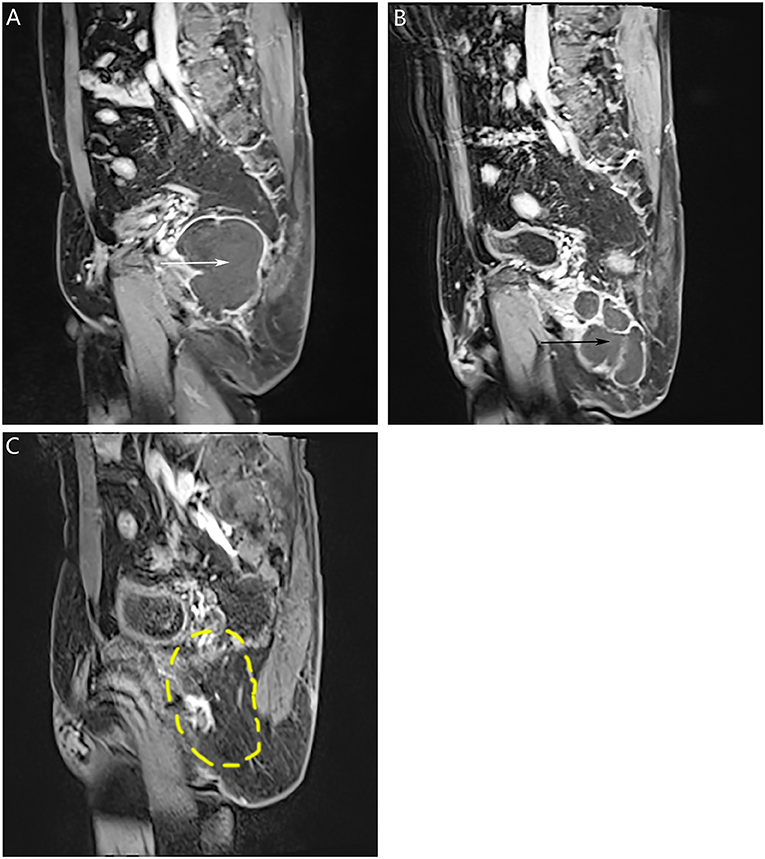 Frontiers Squamous Cell Carcinoma Malignantly Transformed From