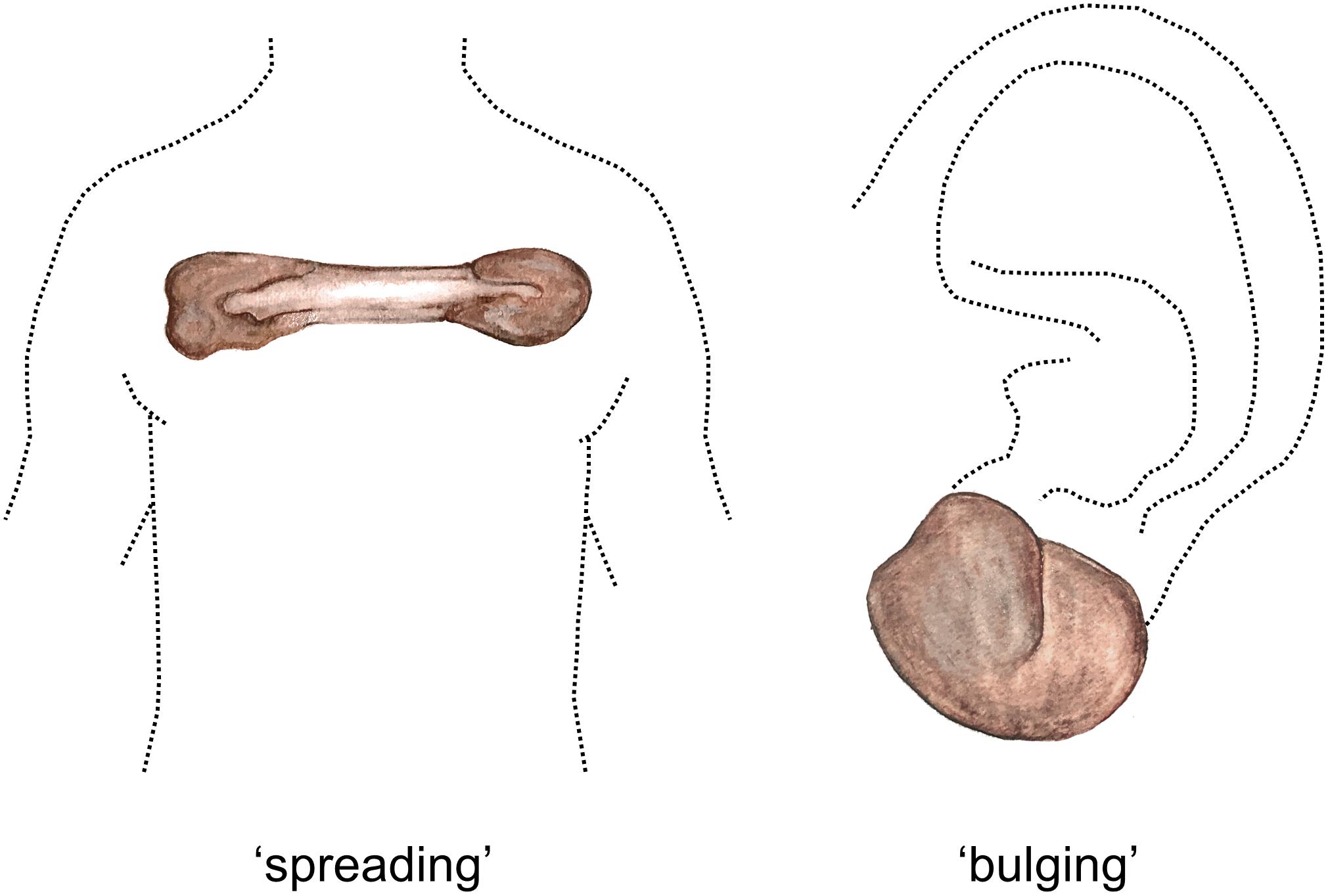 Keloid Research Survey - to understand keloid patient issues