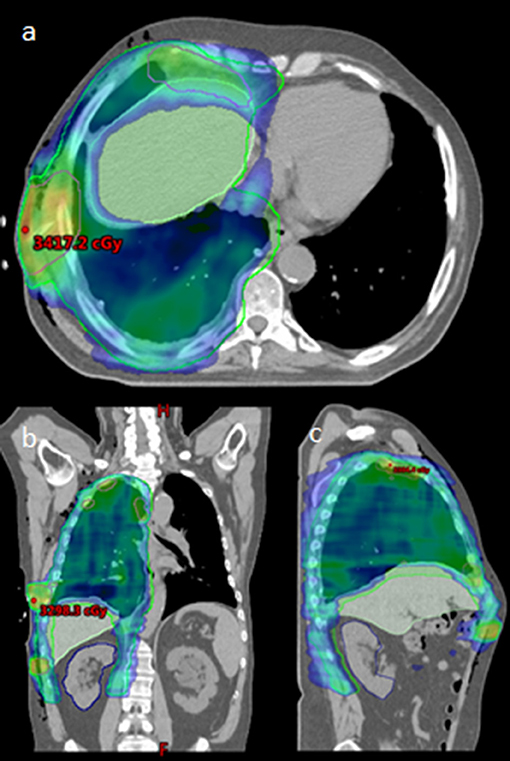 does emphysema show on x ray