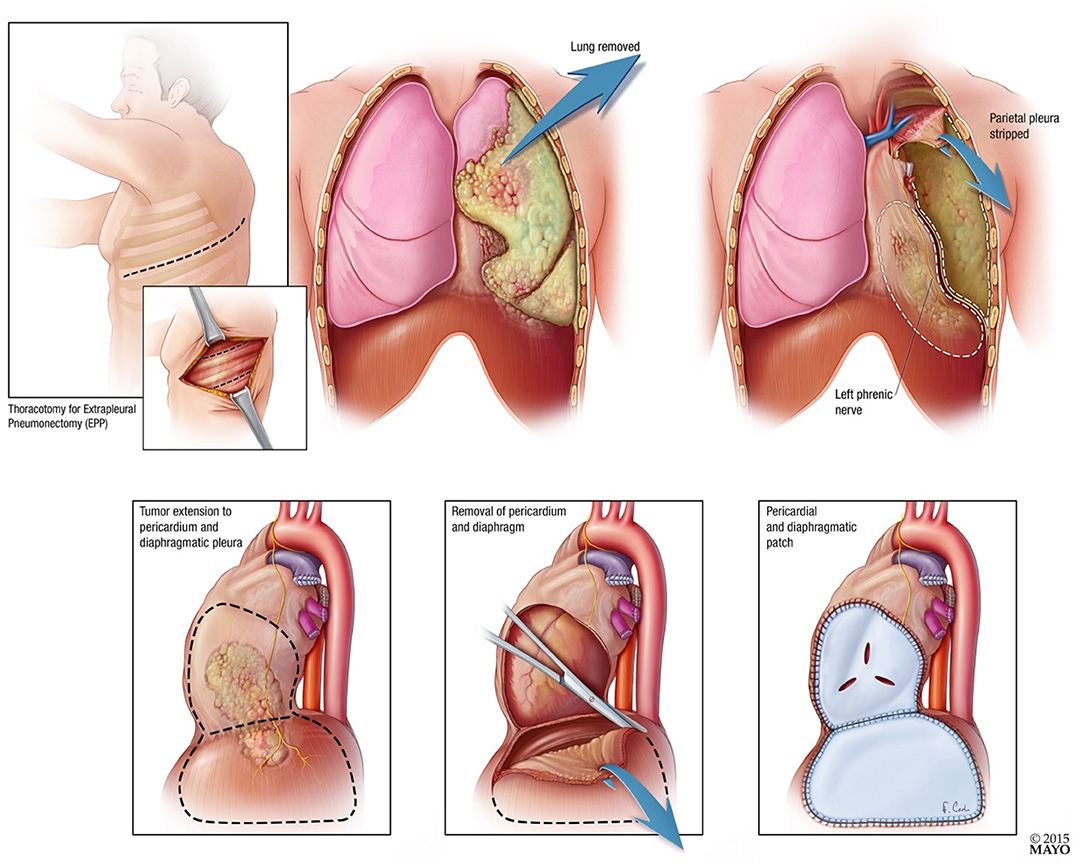 vinorelbine and mesothelioma