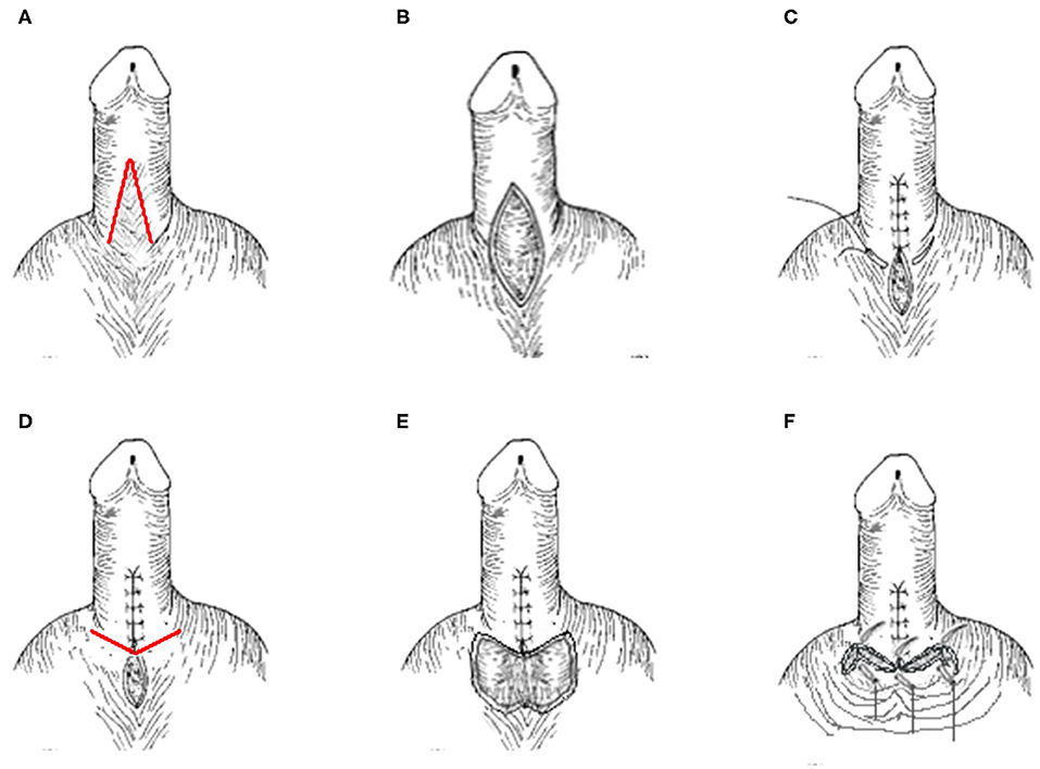 Foreskin Preservation in Penile Surgery