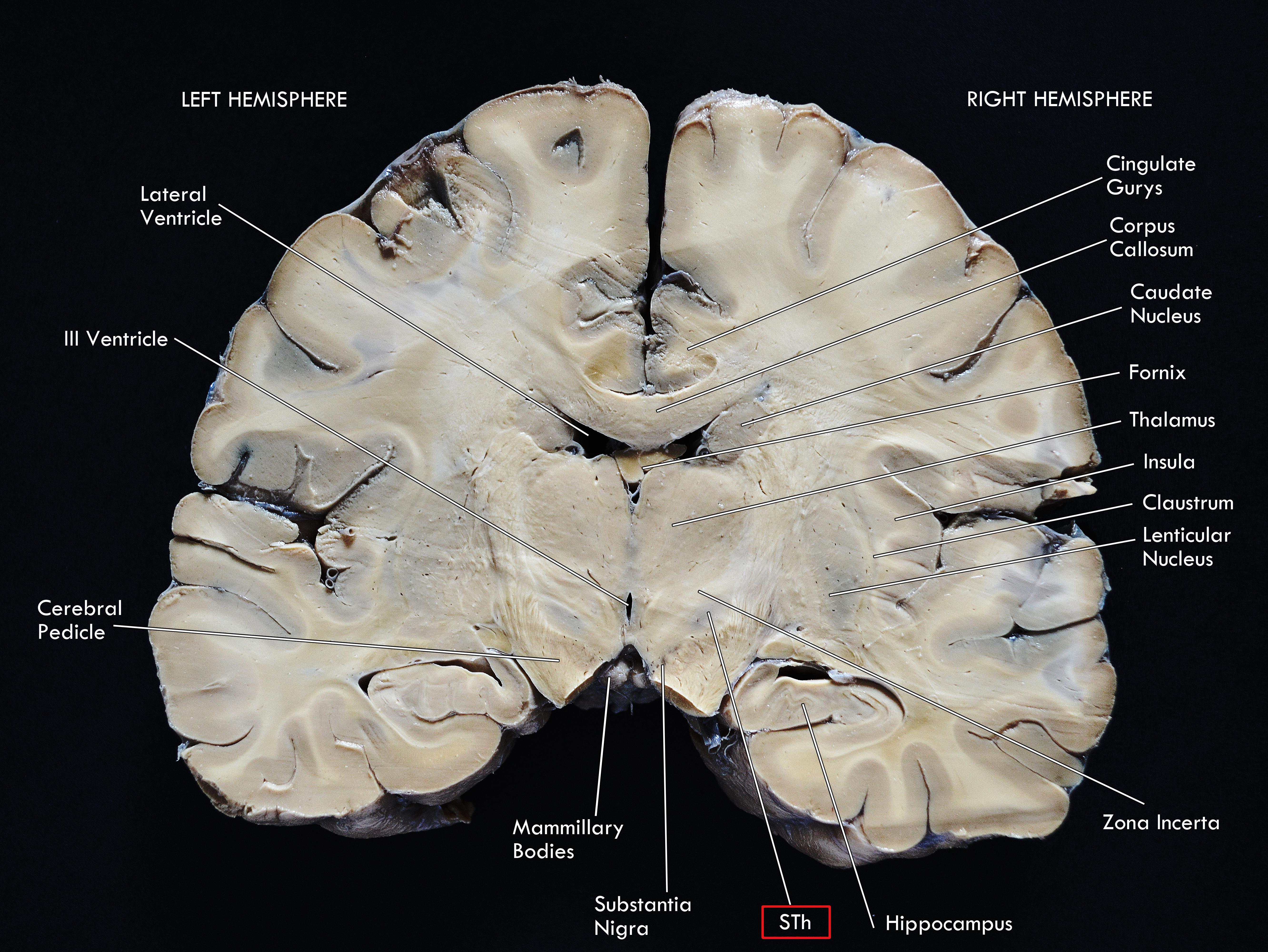Базальные ганглии мозга. Базальные ганглии ядра. Nuclei basales анатомия. Базальные ядра мозга анатомия.