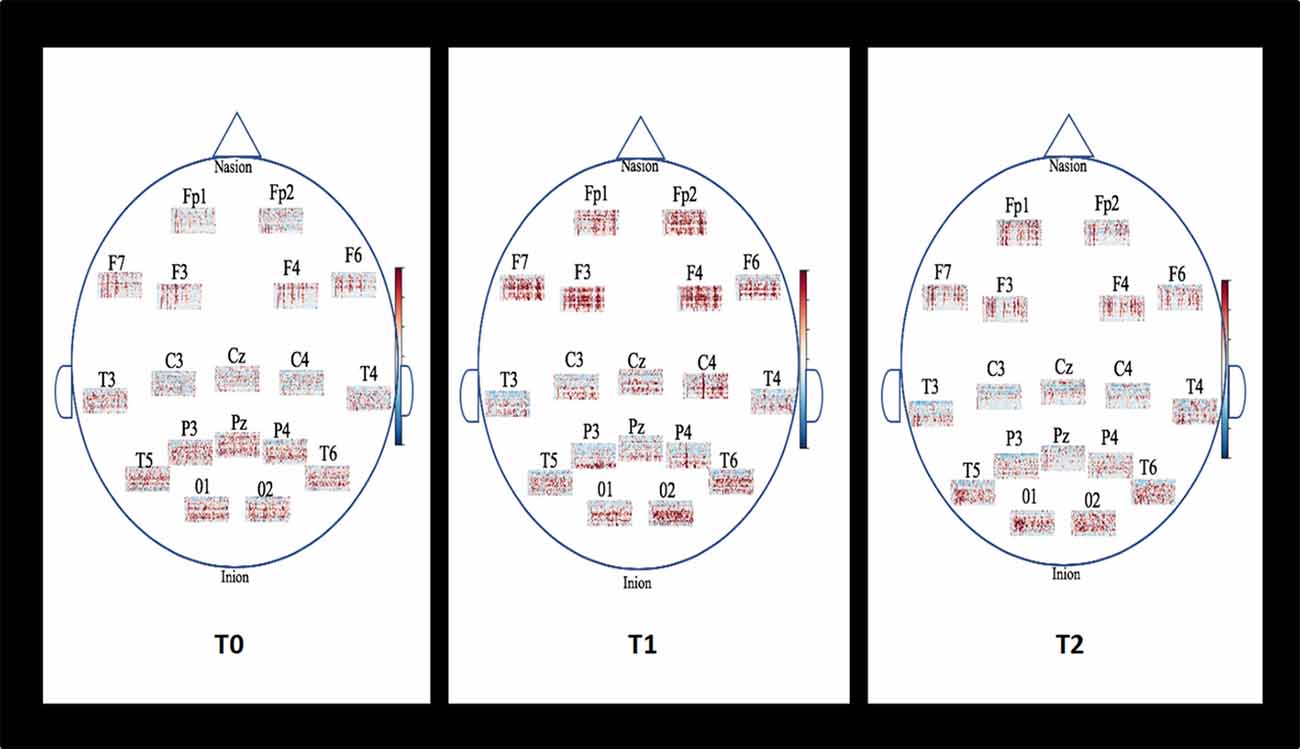 Frontiers  Randomized Controlled Study Evaluating Efficiency of Low  Intensity Transcranial Direct Current Stimulation (tDCS) for Dyspnea Relief  in Mechanically Ventilated COVID-19 Patients in ICU: The tDCS-DYSP-COVID  Protocol