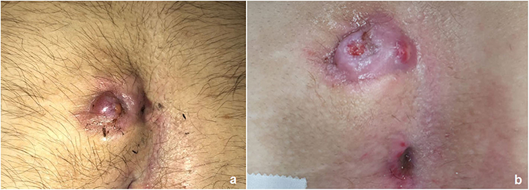 Pilonidal Disease  Boston Children's Hospital