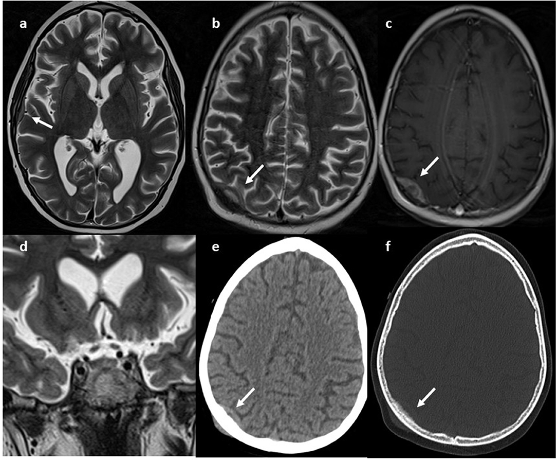 hipertónia adenoma hipertónia magas vérnyomású glaukóma