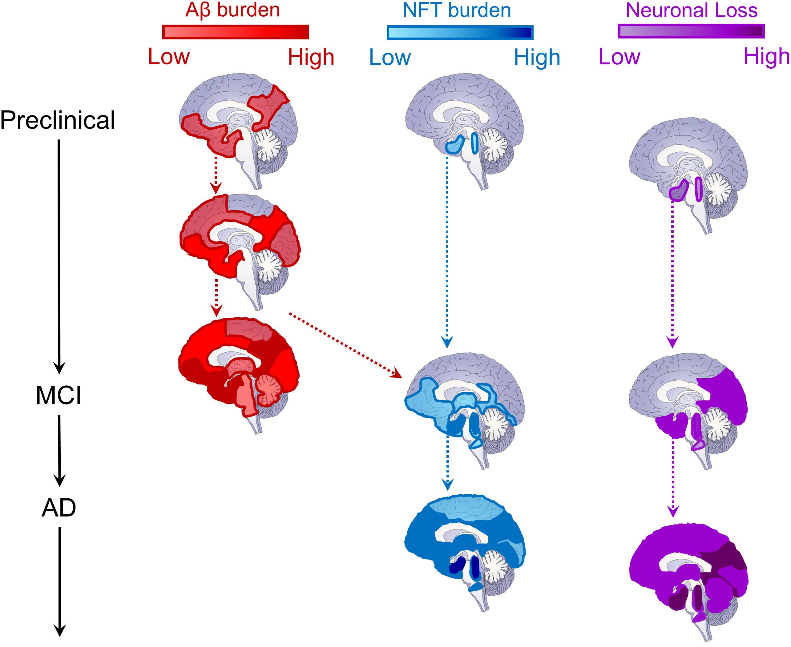 Pathophysiology Of Alzheimer's Disease