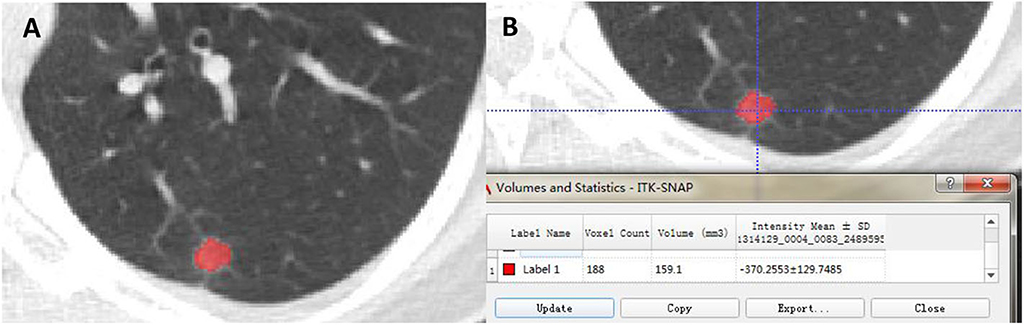 Frontiers | How Does the Delta-Radiomics Better Differentiate Pre ...