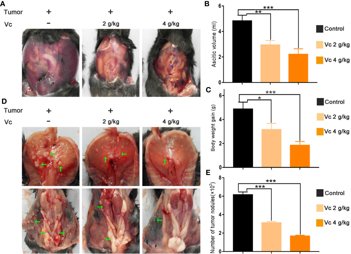 sarcomatoid variant renal cell carcinoma treatment outcome and survival in advanced disease