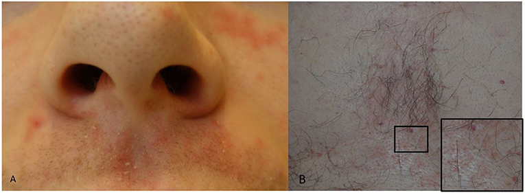 Tinea versicolor caused by Malassezia furfur infection and laboratory  diagnosis