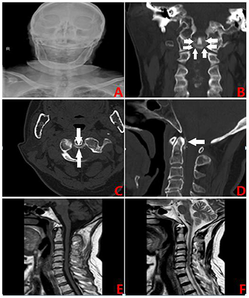 Frontiers Crowned Dens Syndrome A Case Report And Literature Review