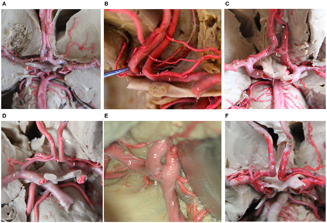Frontiers   Anterior Communicating Artery Aneurysms: Anatomical