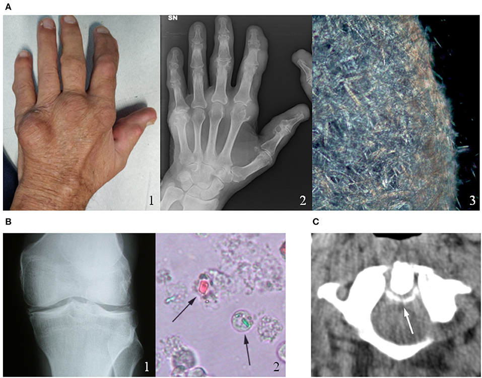 gout vs pseudogout crystals