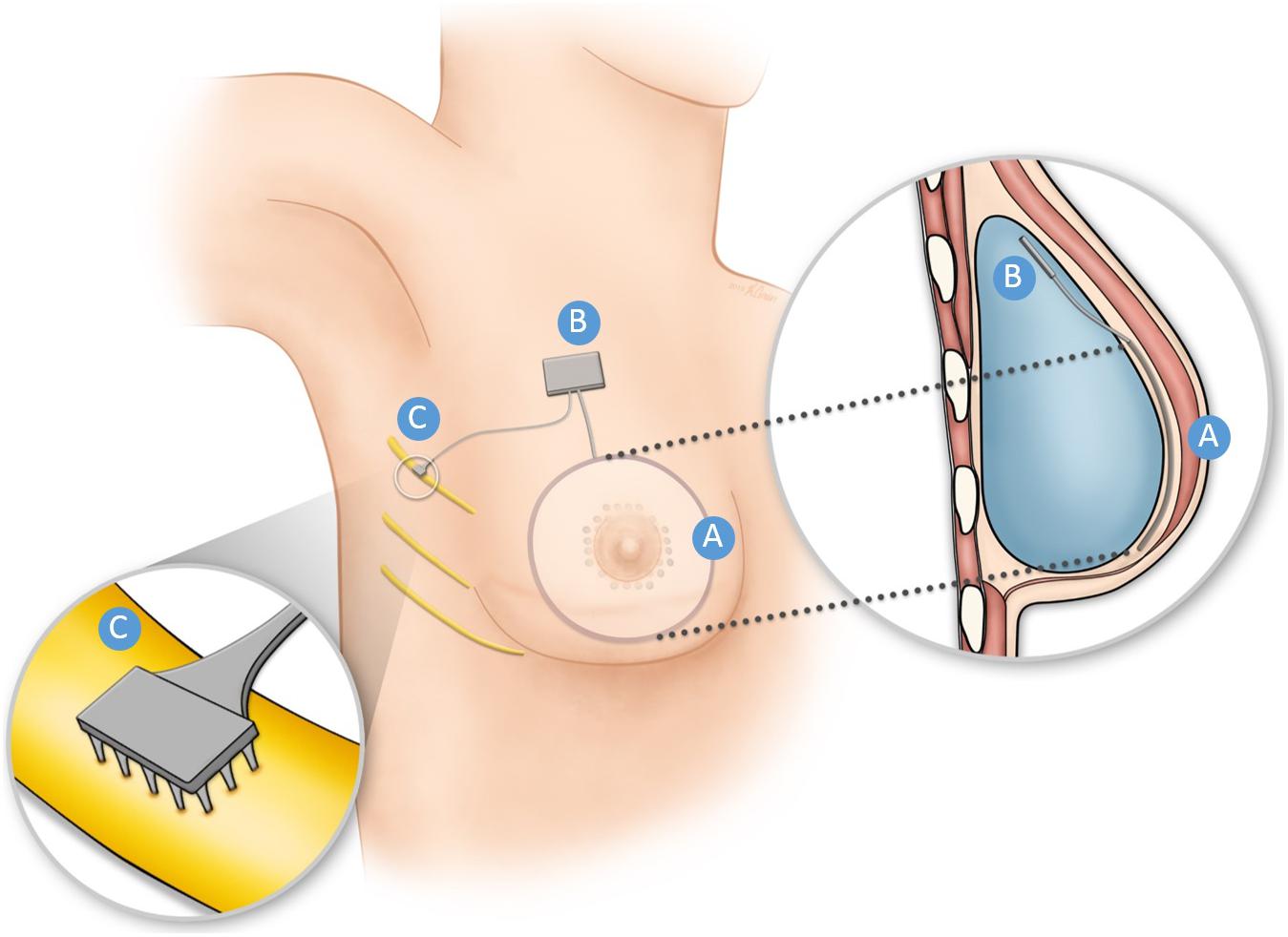 Frontiers Using Bionics to Restore Sensation to Reconstructed Breasts Porn Pic Hd