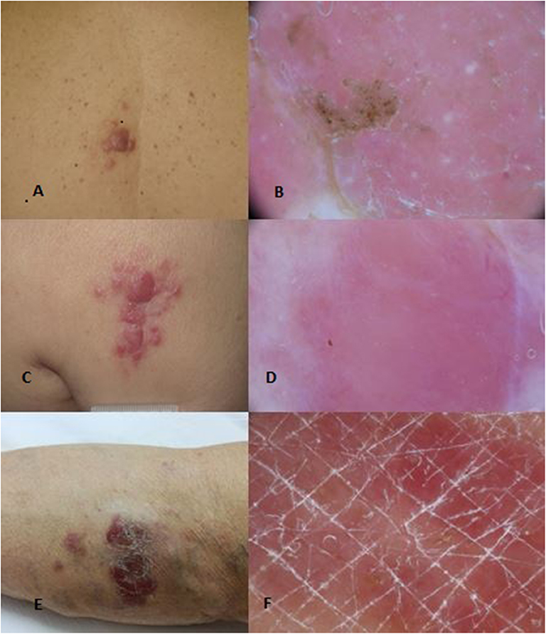 Frontiers Primary Cutaneous B Cell Lymphomas An Update