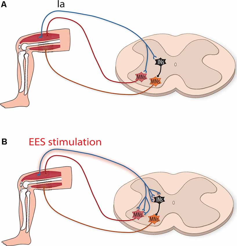 Utilizing a Double Epidural Electrical Stimulation Implant For SCI